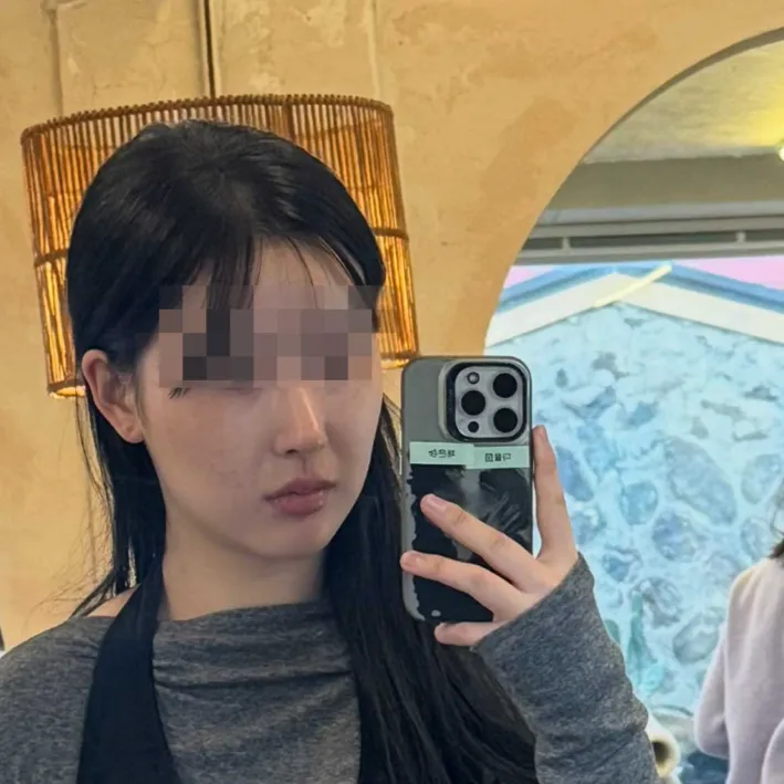 Chin Liposuction 2