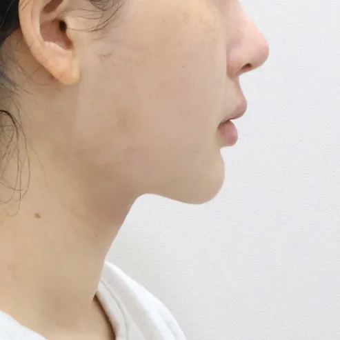 Chin Liposuction — Rewind Plastic Surgery 5