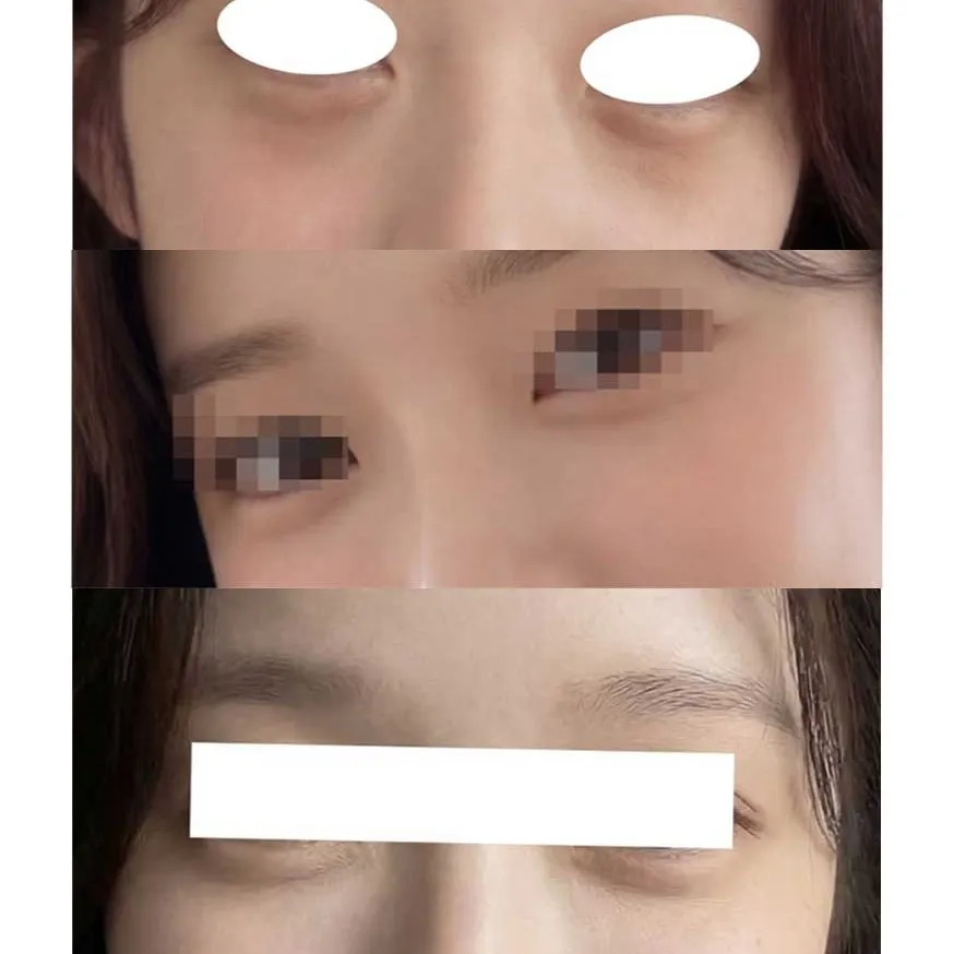 Lower Eyelid Fat Repositioning 2