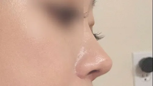 Rhinoplasty Revision — HYUNDAI AESTHETIC PLASTIC SURGERY 1