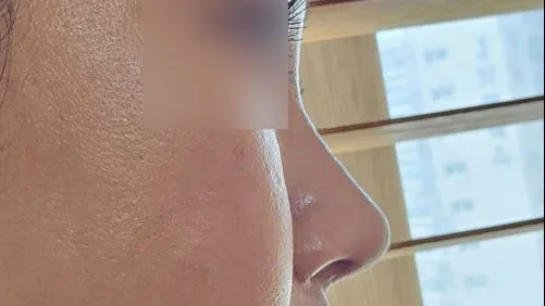 Rhinoplasty Revision — HYUNDAI AESTHETIC PLASTIC SURGERY 2