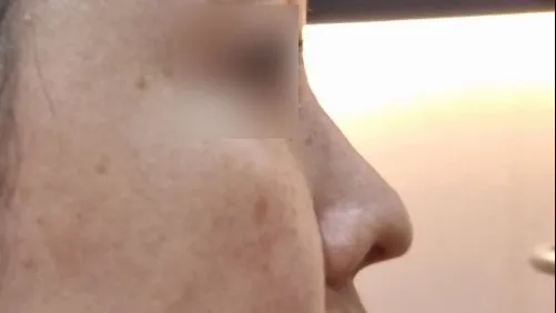 Rhinoplasty Revision — HYUNDAI AESTHETIC PLASTIC SURGERY 3