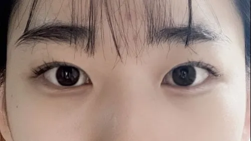 Double Eyelid Surgery 1
