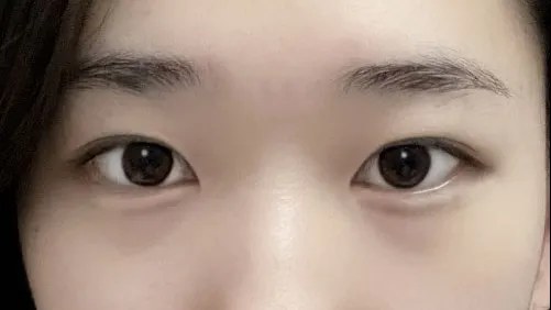 Double Eyelid Surgery 2
