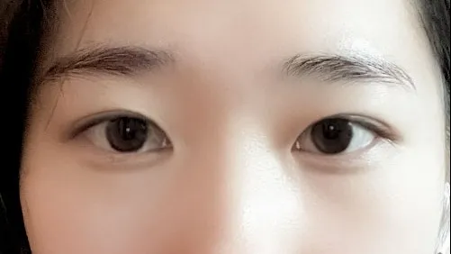 Double Eyelid Surgery — HYUNDAI AESTHETIC PLASTIC SURGERY 3