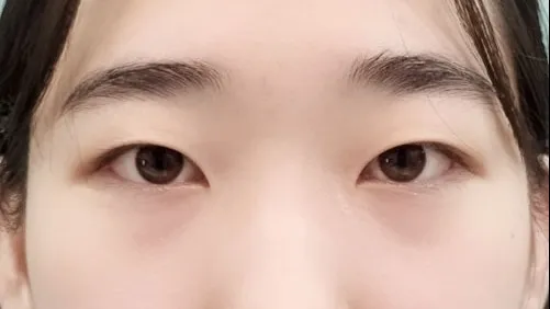 Double Eyelid Surgery — HYUNDAI AESTHETIC PLASTIC SURGERY 4