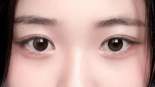 Double Eyelid Surgery 1