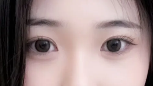 Double Eyelid Surgery 2