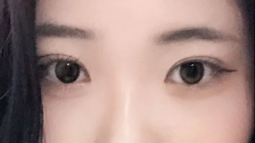 Double Eyelid Surgery — HYUNDAI AESTHETIC PLASTIC SURGERY 3