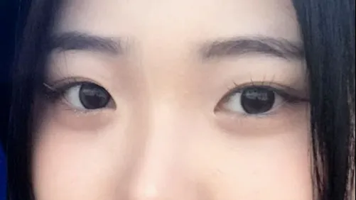 Double Eyelid Surgery — HYUNDAI AESTHETIC PLASTIC SURGERY 4