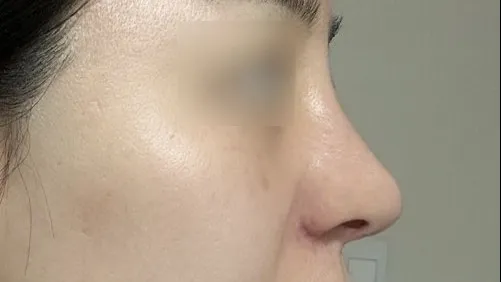 Rhinoplasty Revision 1