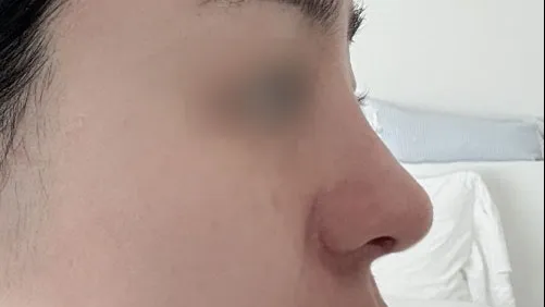 Rhinoplasty Revision 2