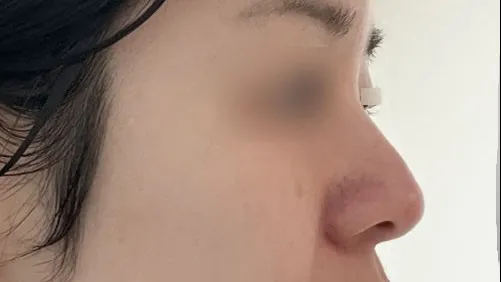 Rhinoplasty Revision — HYUNDAI AESTHETIC PLASTIC SURGERY 3