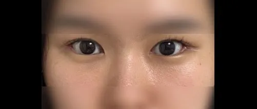 Revision surgery — HYUNDAI AESTHETIC PLASTIC SURGERY 2