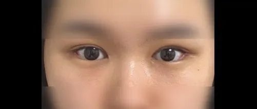 Revision surgery — HYUNDAI AESTHETIC PLASTIC SURGERY 3