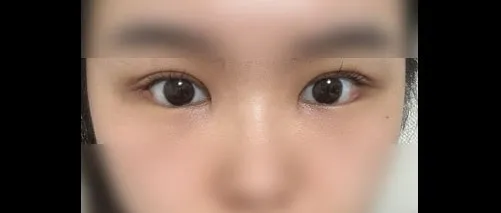 Revision surgery — HYUNDAI AESTHETIC PLASTIC SURGERY 4