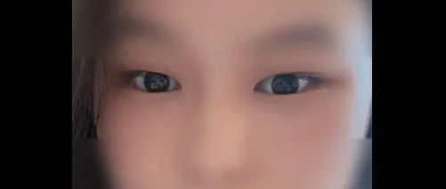 Revision surgery — HYUNDAI AESTHETIC PLASTIC SURGERY 5