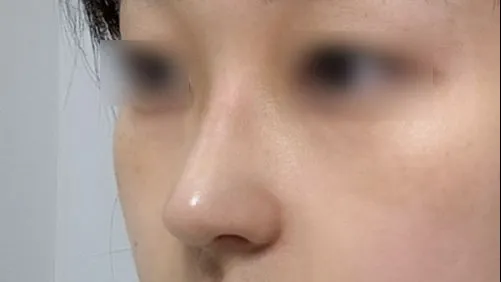 Autologous Tissue — HYUNDAI AESTHETIC PLASTIC SURGERY 4