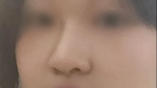 Autologous Tissue — HYUNDAI AESTHETIC PLASTIC SURGERY 5