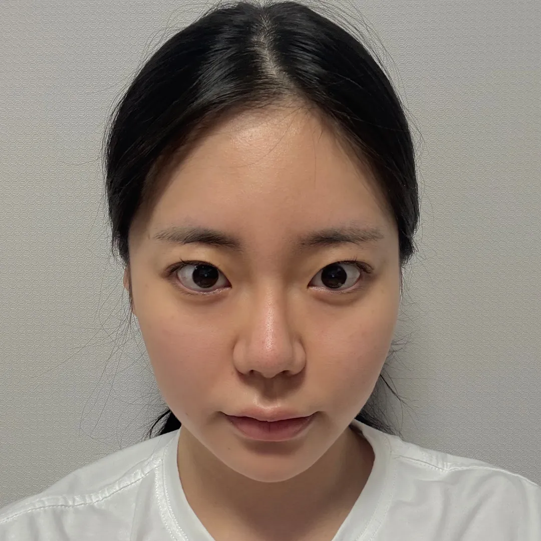 Rhinoplasty Revision 1