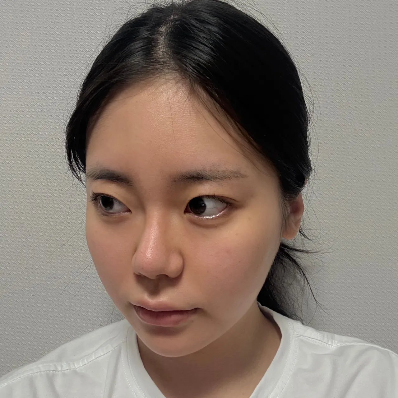 Rhinoplasty Revision — Luho Plastic Surgery 2