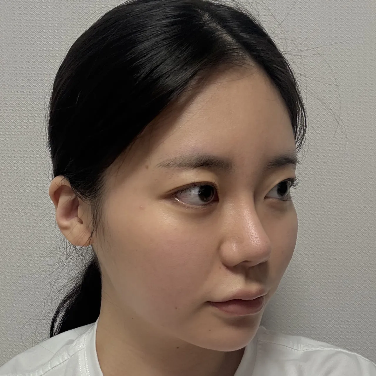 Rhinoplasty Revision — Luho Plastic Surgery 3