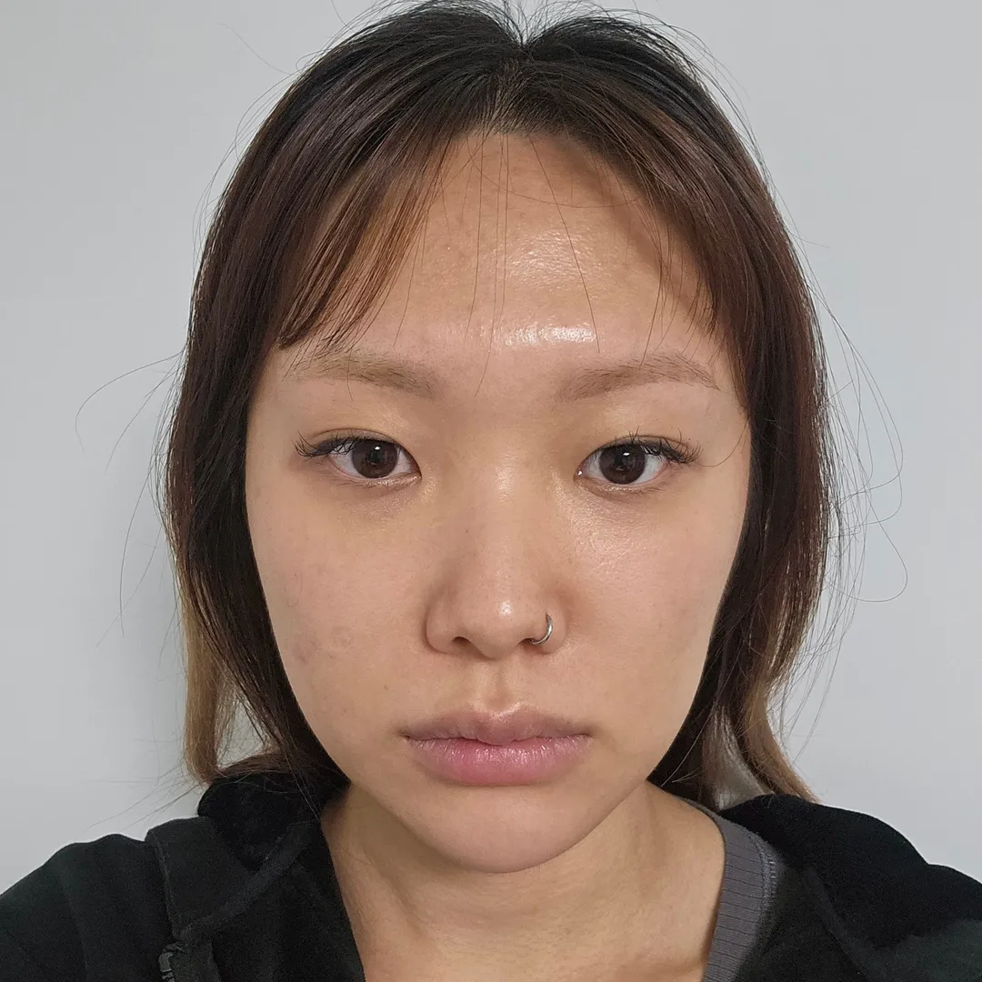 Natural Adhesion Double Eyelid Surgery, Epicanthoplasty, Hump Nose 1