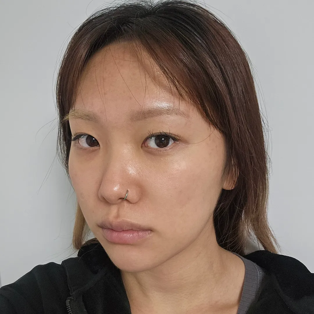 Natural Adhesion Double Eyelid Surgery, Epicanthoplasty, Hump Nose 2