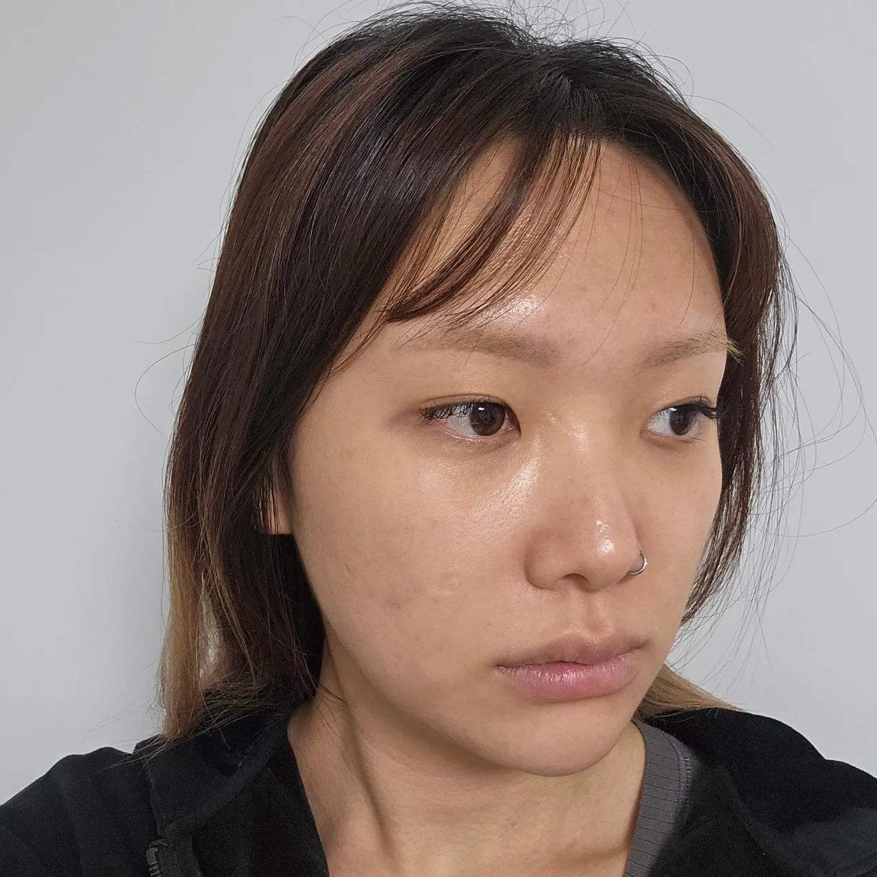Natural Adhesion Double Eyelid Surgery, Epicanthoplasty, Hump Nose — Luho Plastic Surgery 3
