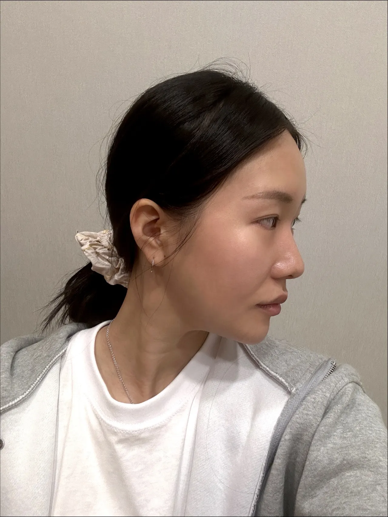 Revision surgery, Hump Nose, Crooked Nose — Luho Plastic Surgery 2