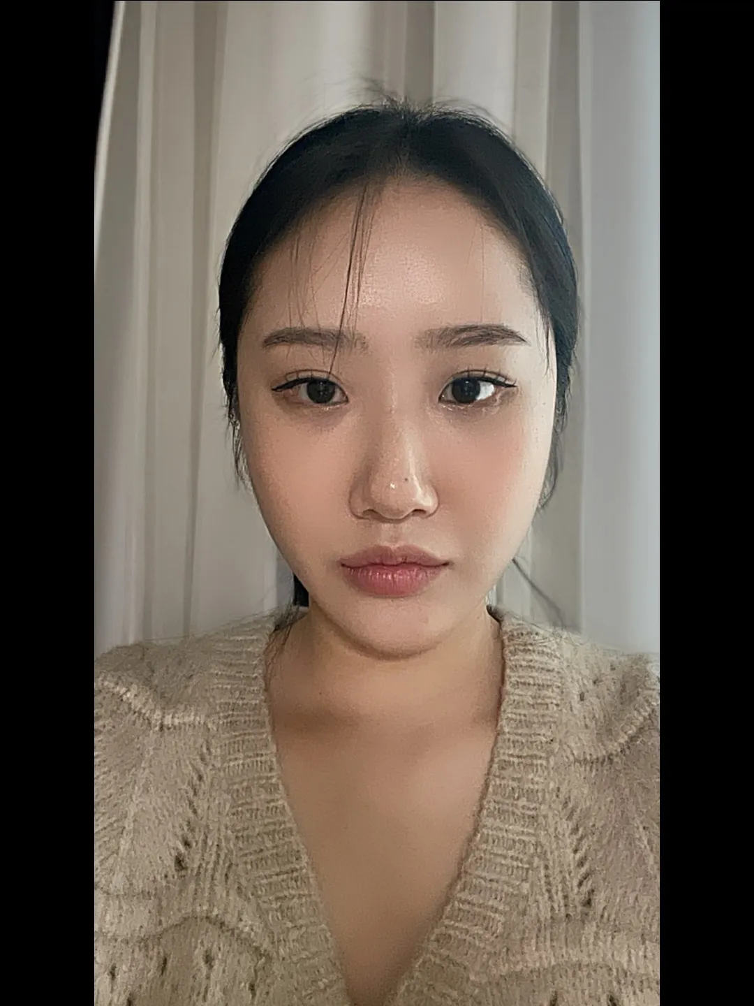 Natural Adhesion Double Eyelid Surgery, Ptosis Correction, Hump Nose 1