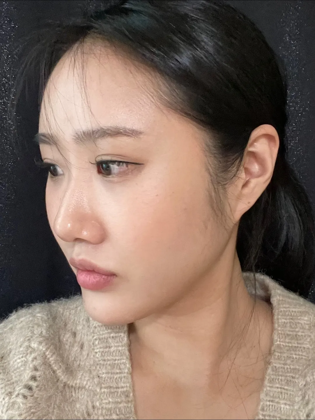 Natural Adhesion Double Eyelid Surgery, Ptosis Correction, Hump Nose 2