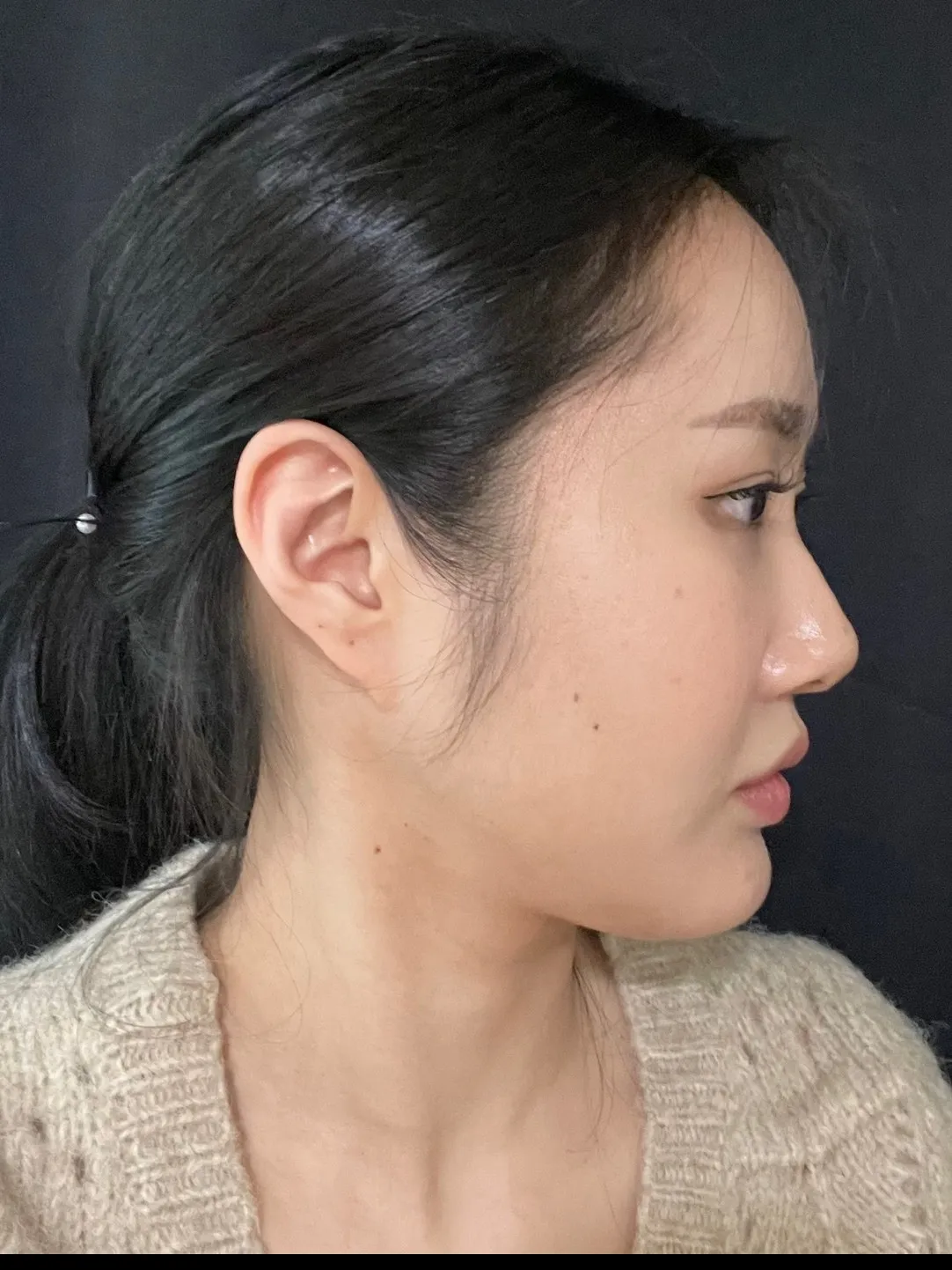 Natural Adhesion Double Eyelid Surgery, Ptosis Correction, Hump Nose — Luho Plastic Surgery 3