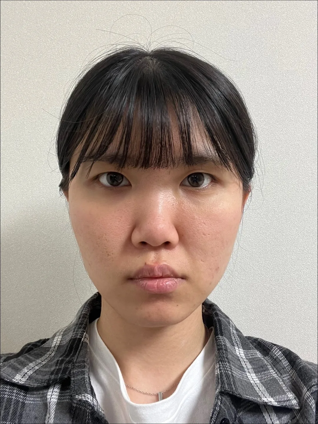 Epicanthoplasty, Natural Adhesion Double Eyelid Surgery, Low Bridge Nose 1