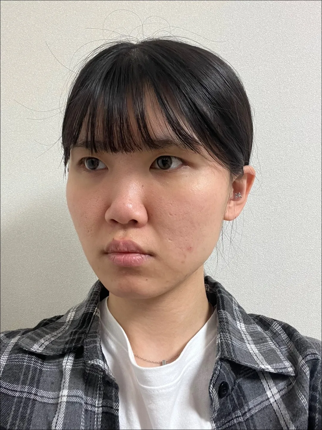 Epicanthoplasty, Natural Adhesion Double Eyelid Surgery, Low Bridge Nose — Luho Plastic Surgery 2