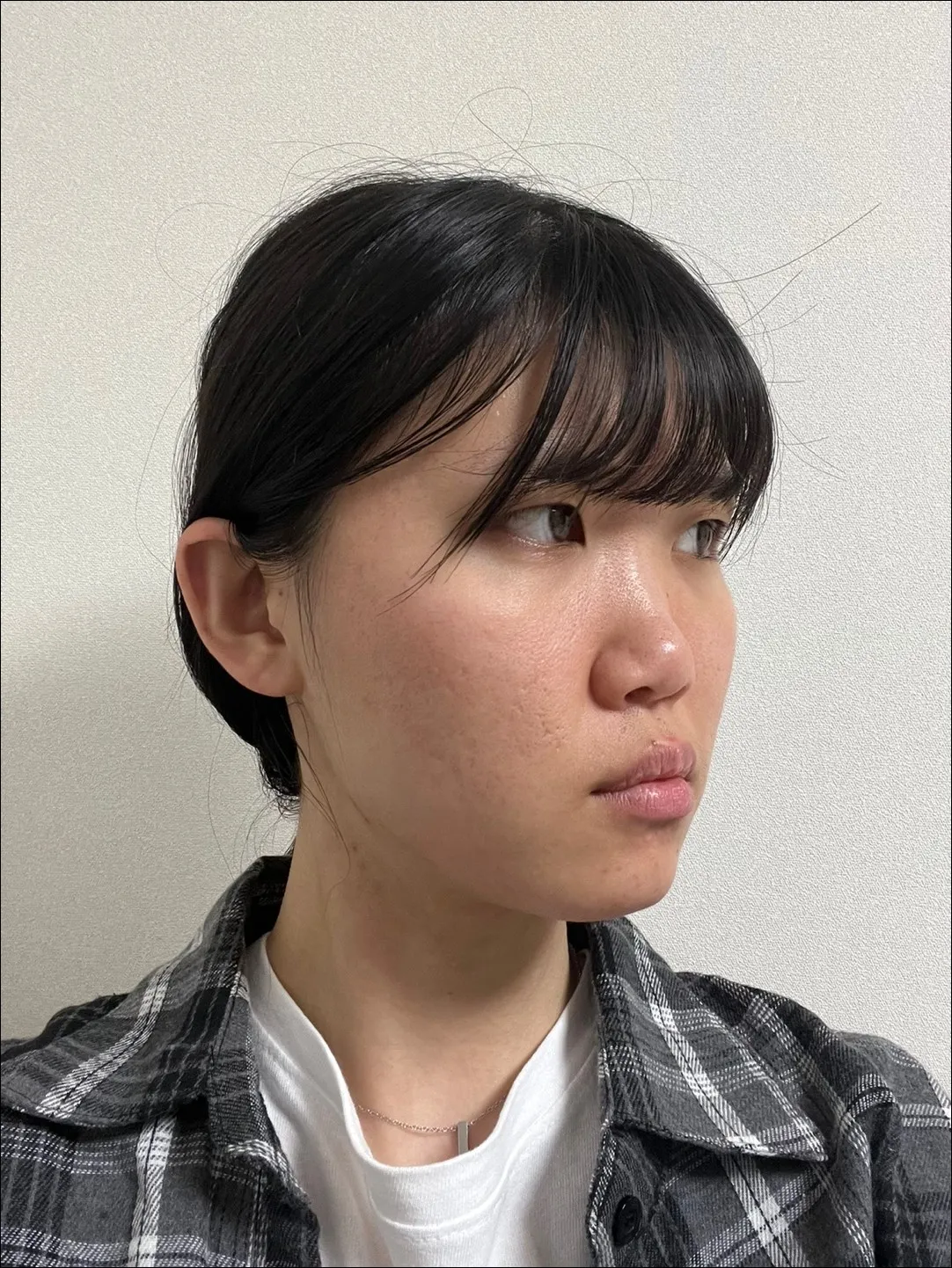 Epicanthoplasty, Natural Adhesion Double Eyelid Surgery, Low Bridge Nose — Luho Plastic Surgery 3