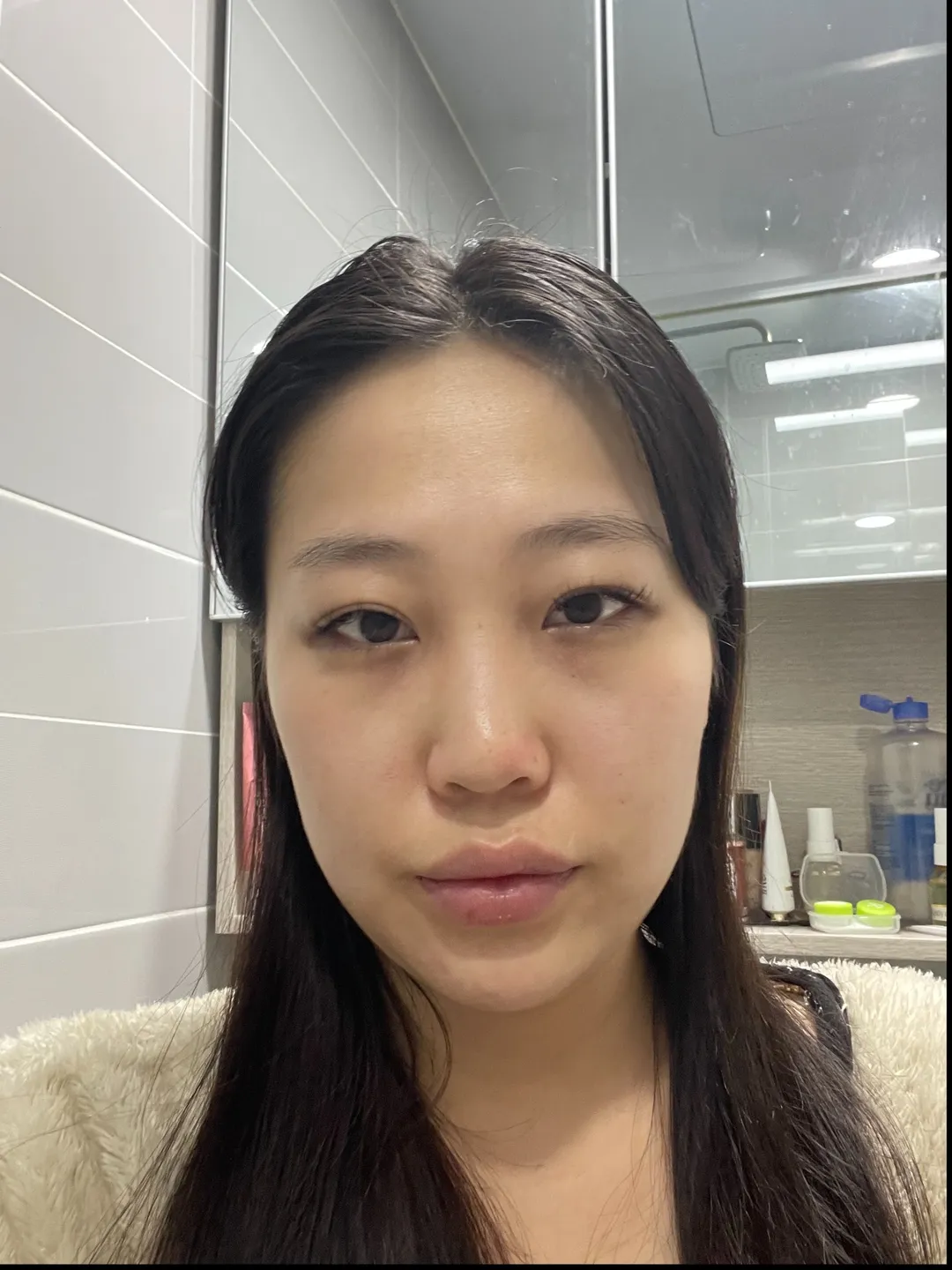 Revision surgery, Low Bridge Nose, Botox, Chin Liposuction 1