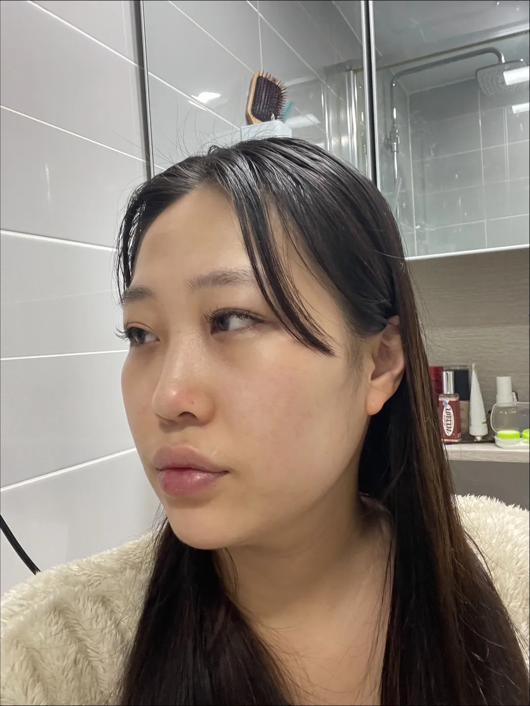 Revision surgery, Low Bridge Nose, Botox, Chin Liposuction 2