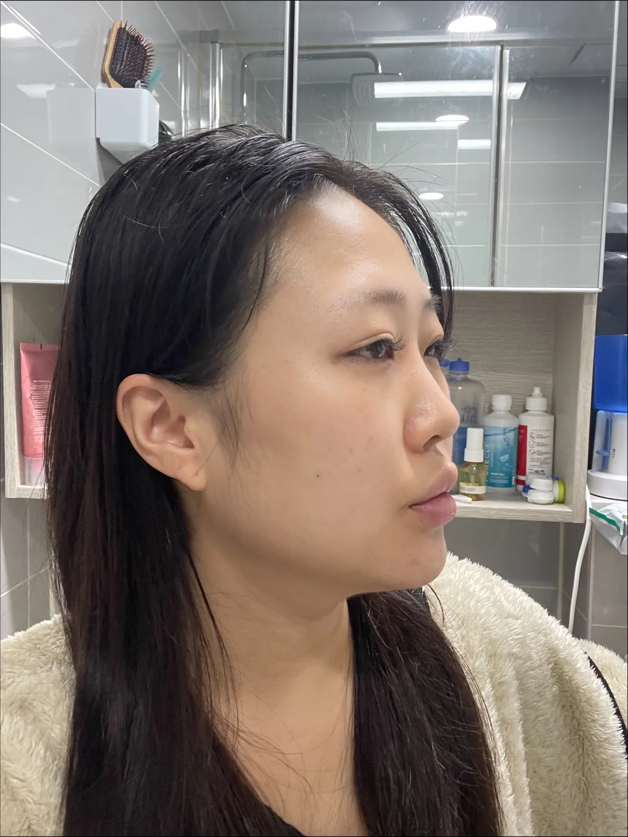 Revision surgery, Low Bridge Nose, Botox, Chin Liposuction — Luho Plastic Surgery 3