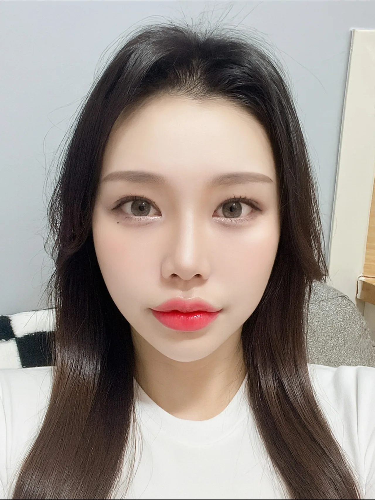 Revision surgery, Low Bridge Nose, Botox, Chin Liposuction — Luho Plastic Surgery 4