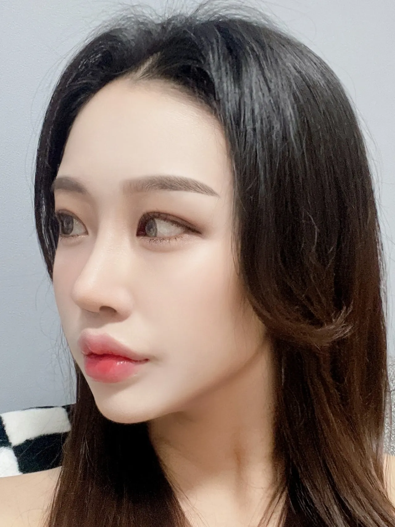 Revision surgery, Low Bridge Nose, Botox, Chin Liposuction — Luho Plastic Surgery 5
