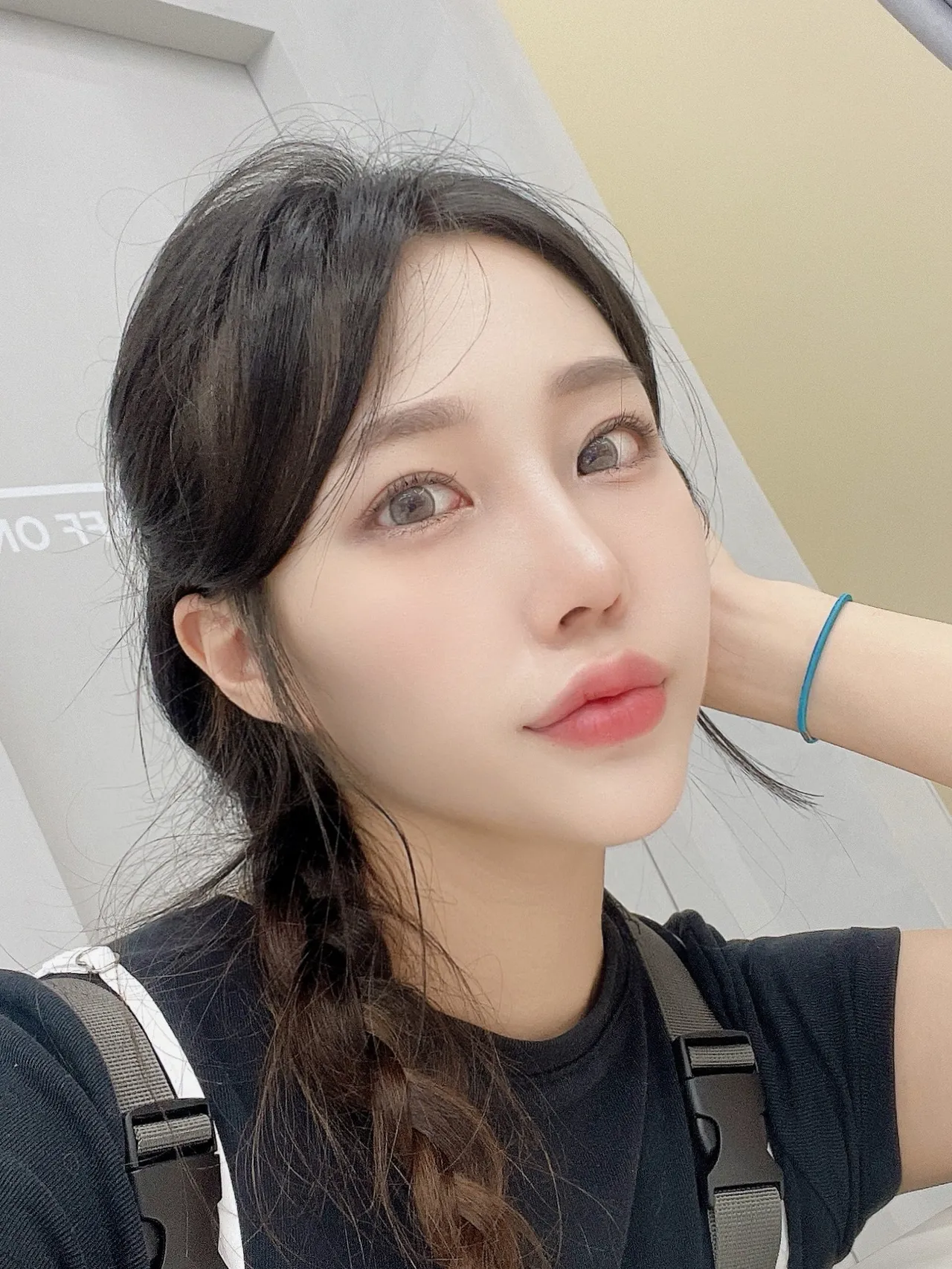 Revision surgery, Low Bridge Nose, Botox, Chin Liposuction — Luho Plastic Surgery 6