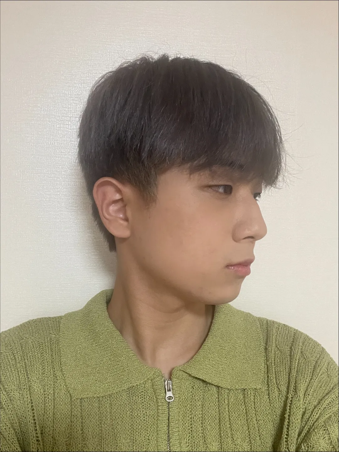 Incisional Double Eyelid Surgery, Ptosis Correction, Epicanthoplasty, Hump Nose, Crooked Nose 2