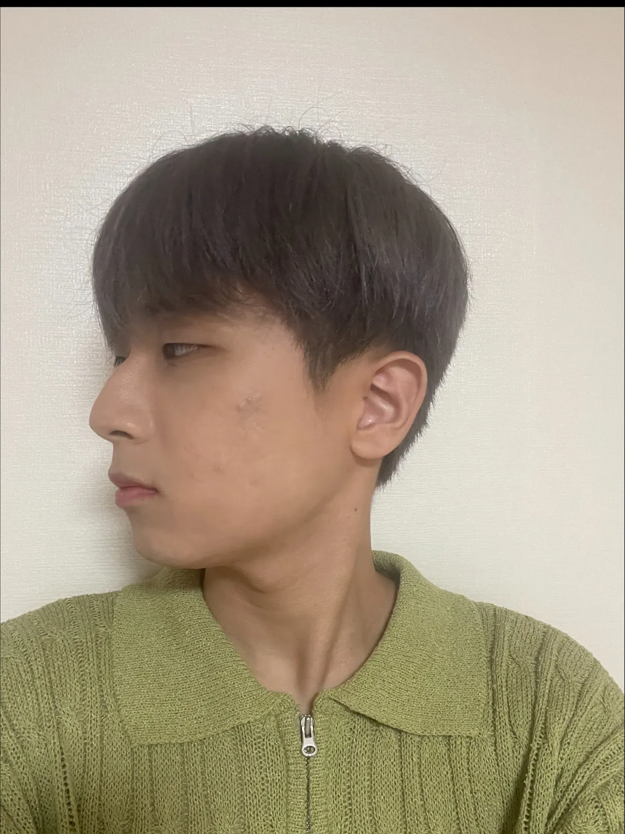 Incisional Double Eyelid Surgery, Ptosis Correction, Epicanthoplasty, Hump Nose, Crooked Nose — Luho Plastic Surgery 3