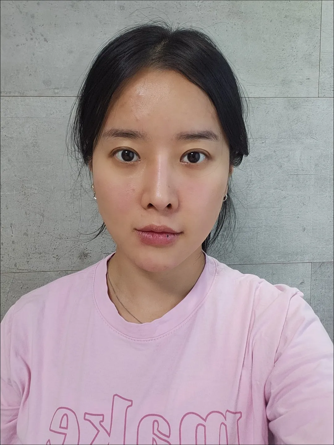 Lower Eyelid Fat Repositioning, Full-Face Thread lift 1