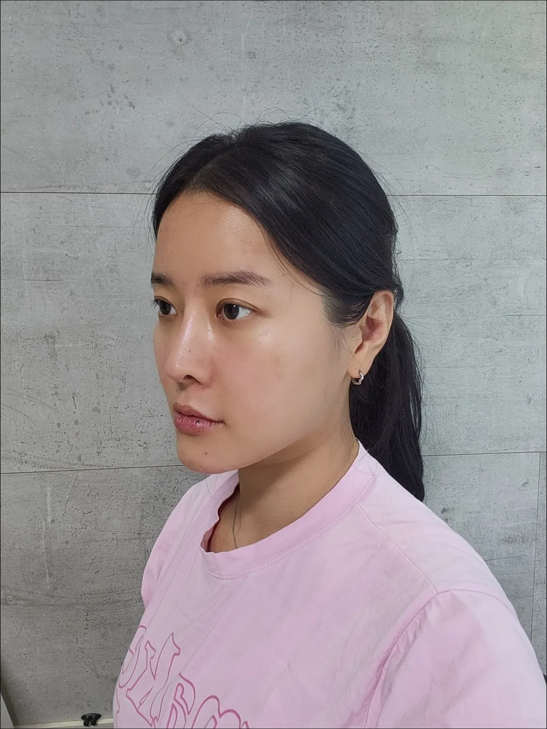 Lower Eyelid Fat Repositioning, Full-Face Thread lift 2