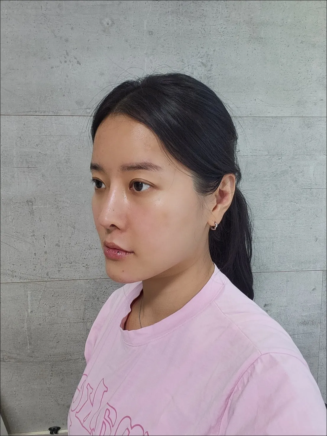 Lower Eyelid Fat Repositioning, Full-Face Thread lift — Luho Plastic Surgery 2