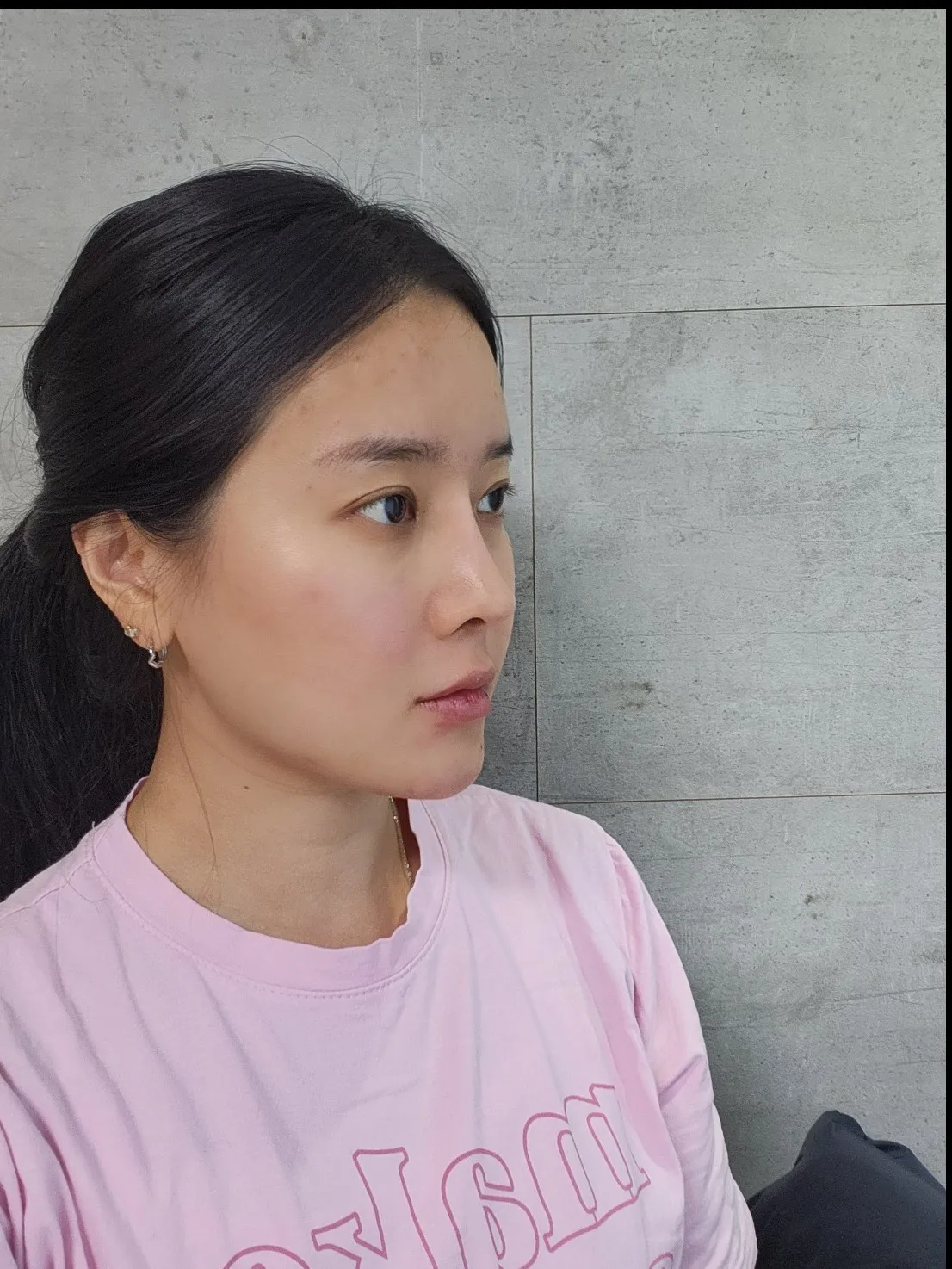 Lower Eyelid Fat Repositioning, Full-Face Thread lift — Luho Plastic Surgery 3