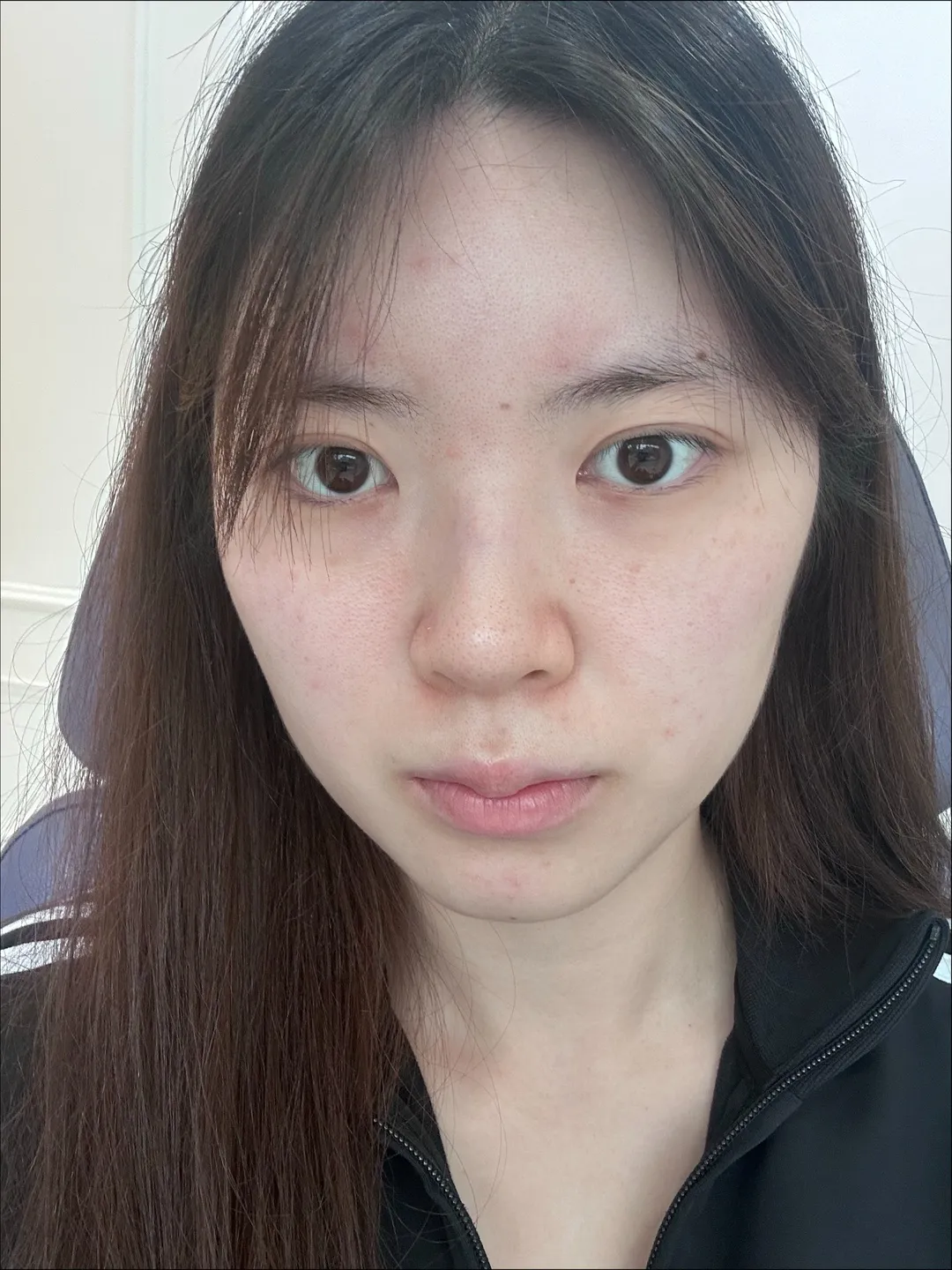 Chin Liposuction, Hump Nose, Low Bridge Nose 1
