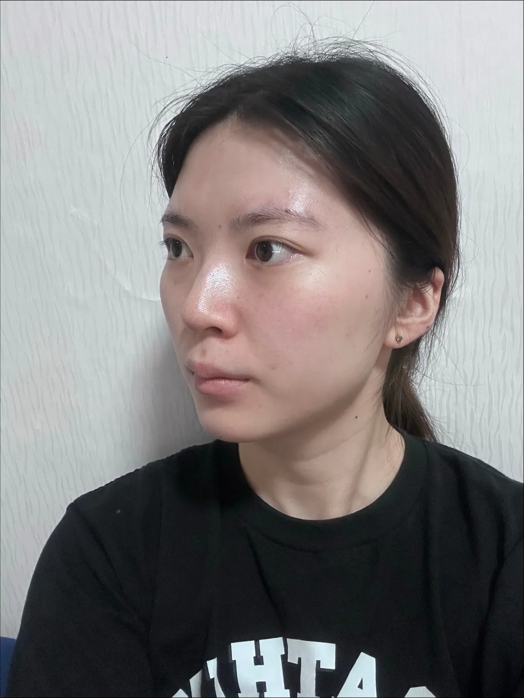 Chin Liposuction, Hump Nose, Low Bridge Nose 2